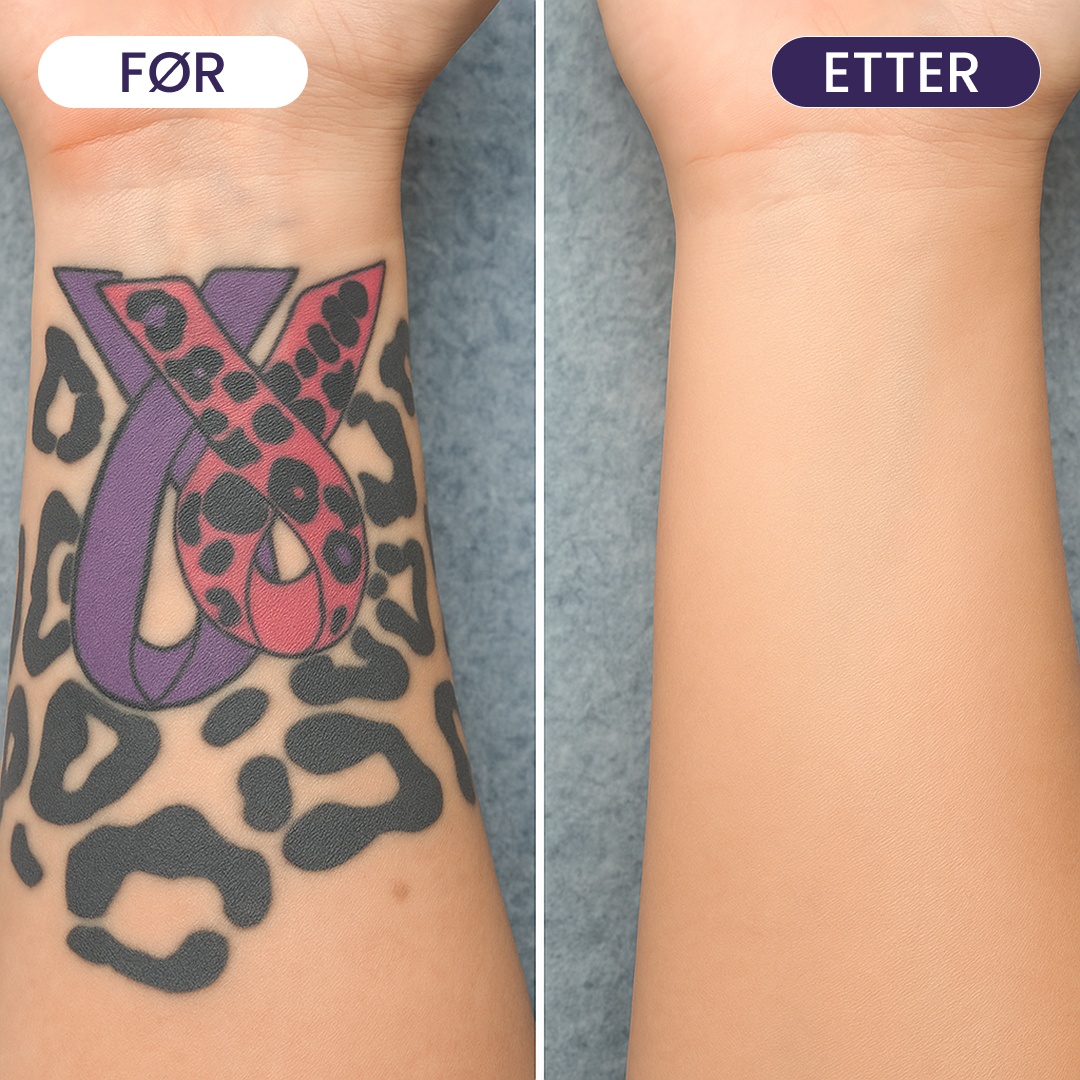 Body Coverage Cream - Dekk mørke flekker, urenheter og akne enkelt