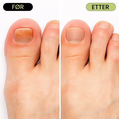 7 Day Nail Treatment - Fjern neglesopp uten sterke kjemikalier