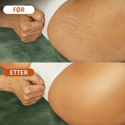 Besque™ - Fjern strekkmerker og stram opp huden