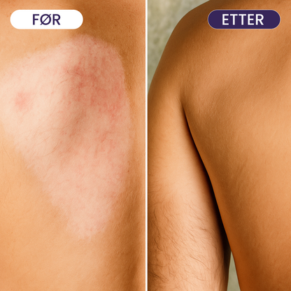 Body Coverage Cream - Dekk mørke flekker, urenheter og akne enkelt