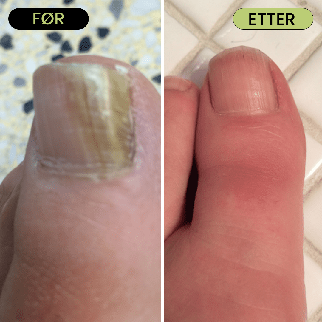 7 Day Nail Treatment - Fjern neglesopp uten sterke kjemikalier