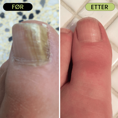 7 Day Nail Treatment - Fjern neglesopp uten sterke kjemikalier